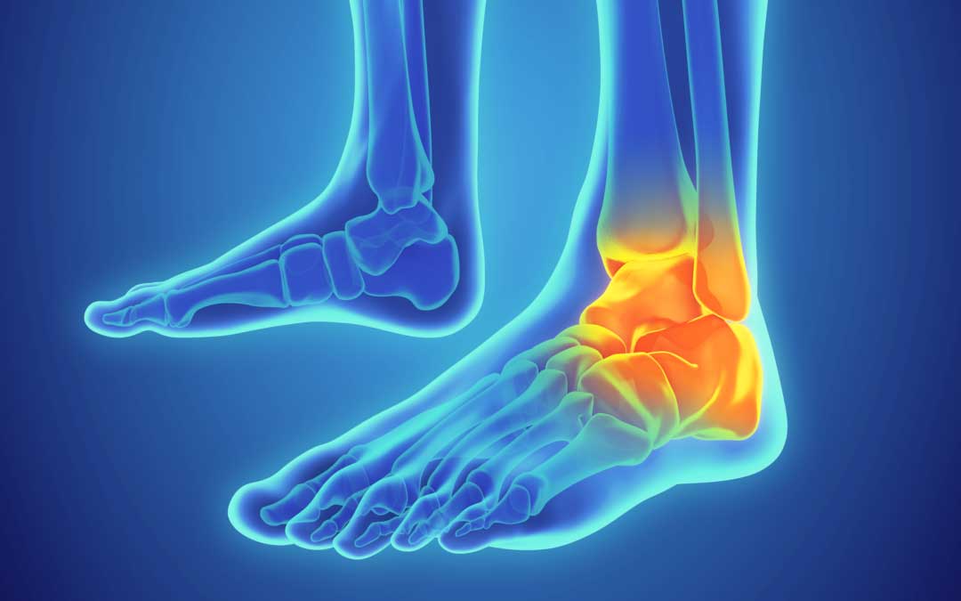 What Is Sprained Ankle What Are Its Symptoms Causes And Treatment