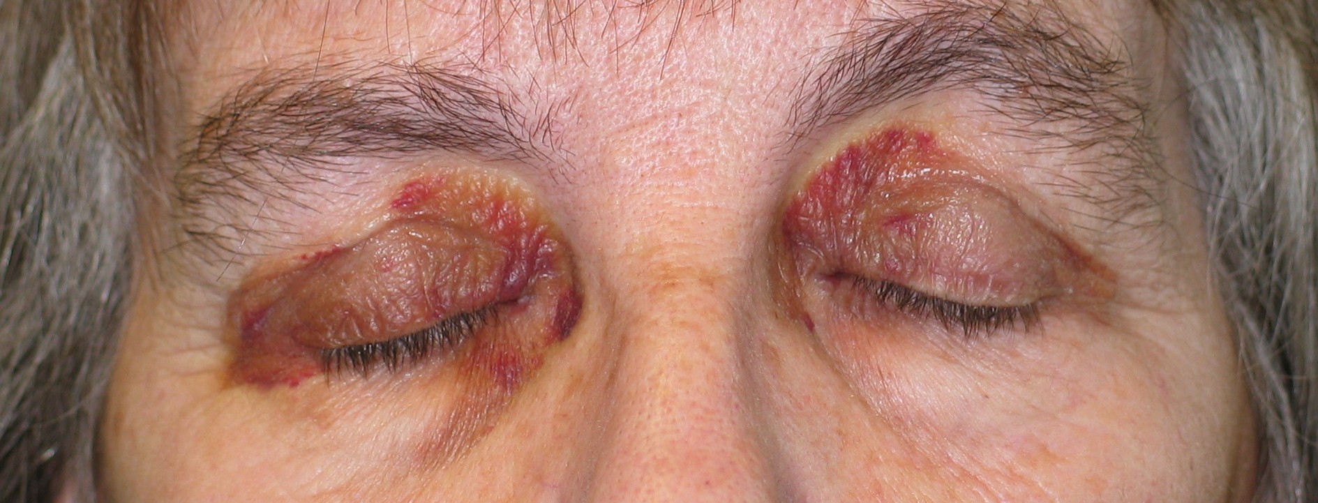 Amyloidosis: A Rare Disease