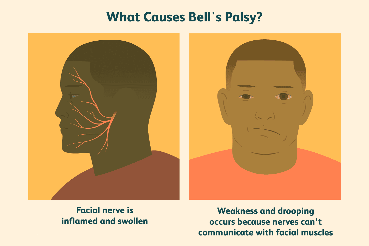Causes of Bell’s Palsy