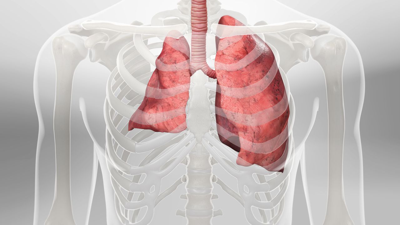 Rare Lung Condition: Pneumothorax or Collapsed Lung