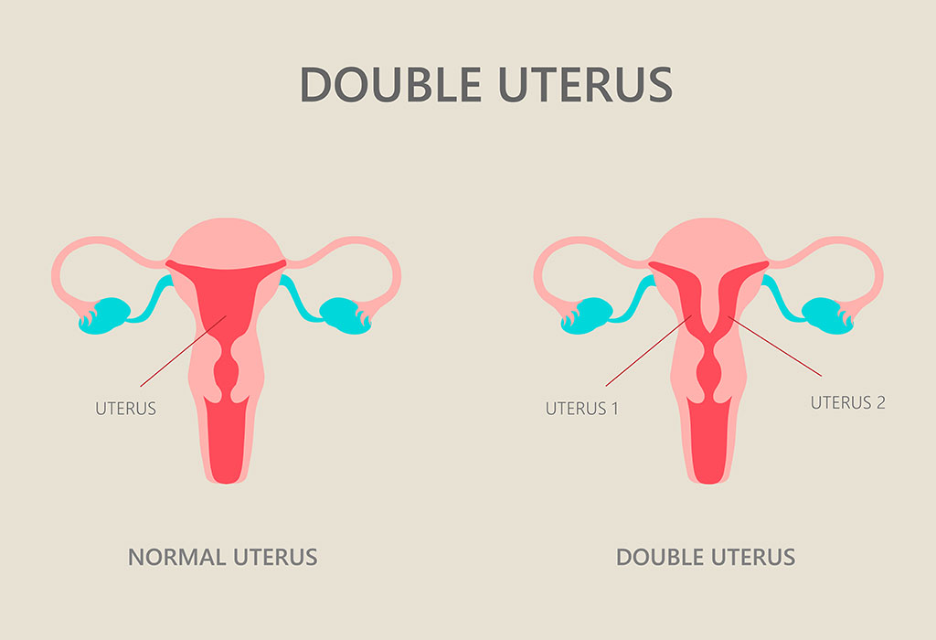 Double Uterus - Symptoms, Causes, and Treatment
