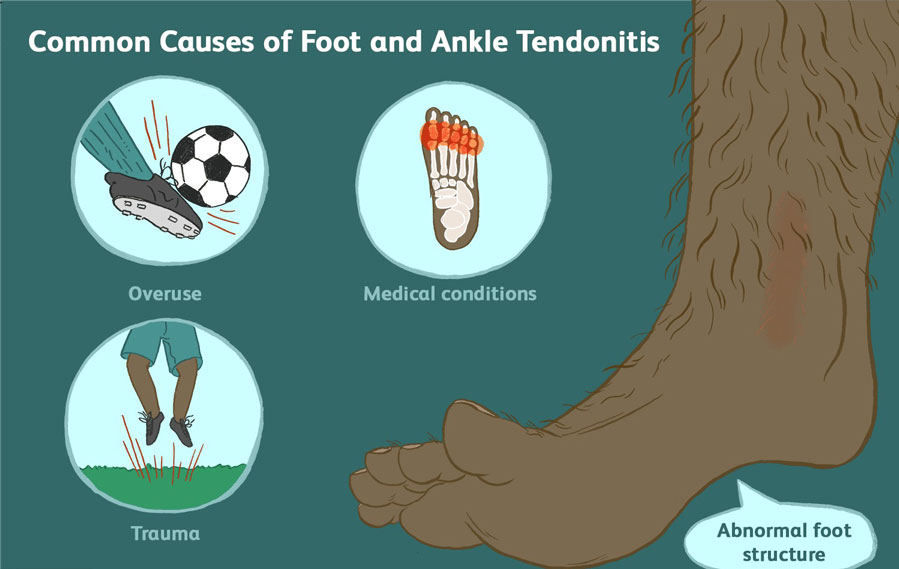 Symptoms of Foot and Ankle Tendonitis