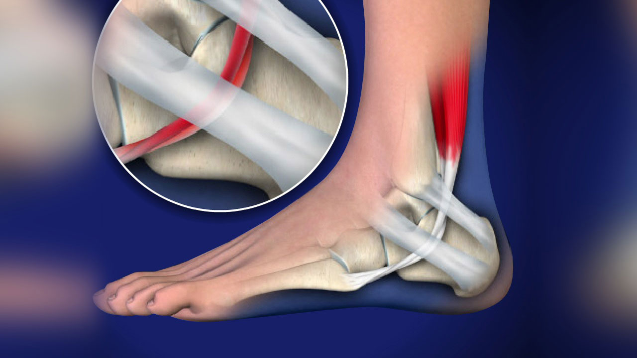 Cause of Foot and Ankle Tendonitis