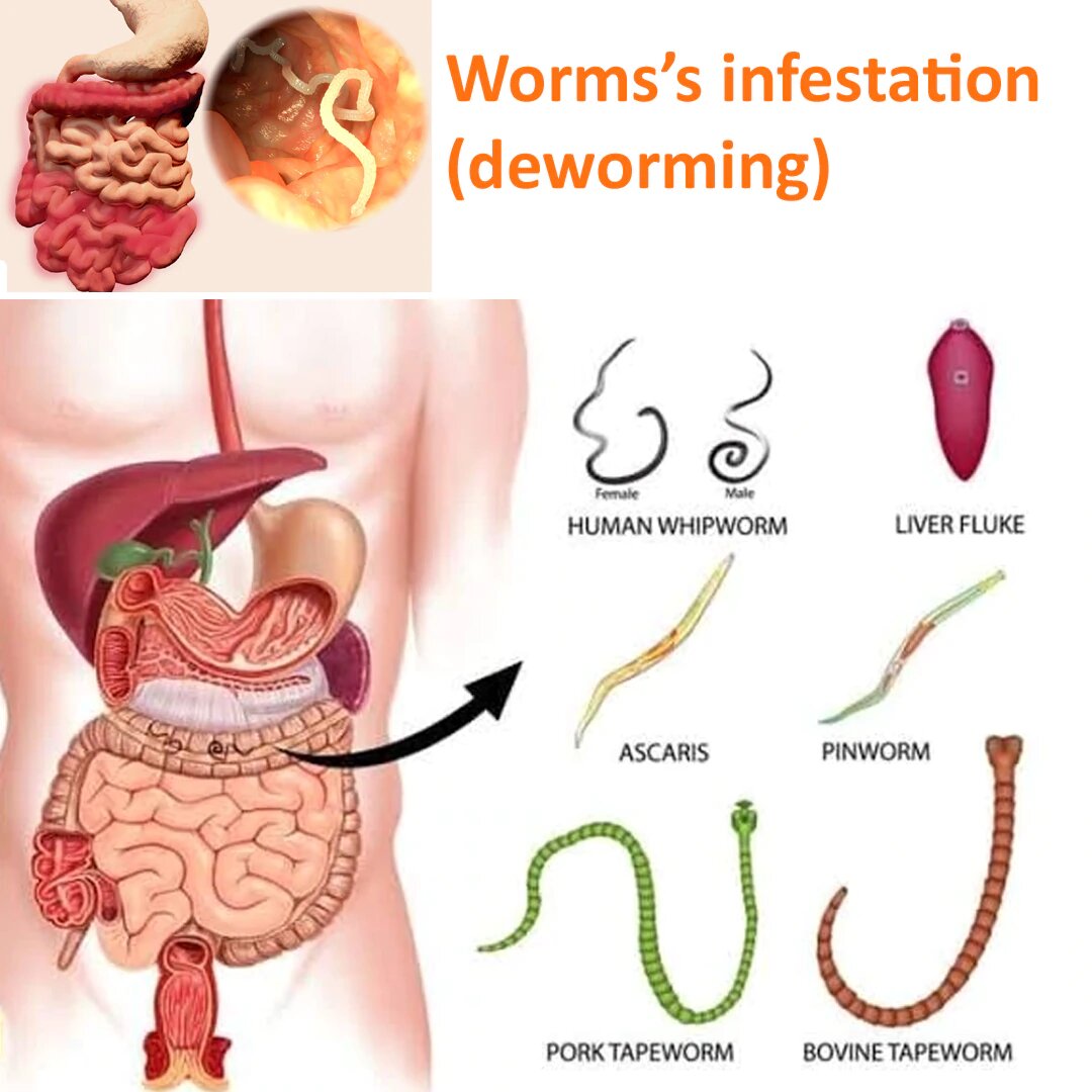 
                    What is Pinworm Infection?

 