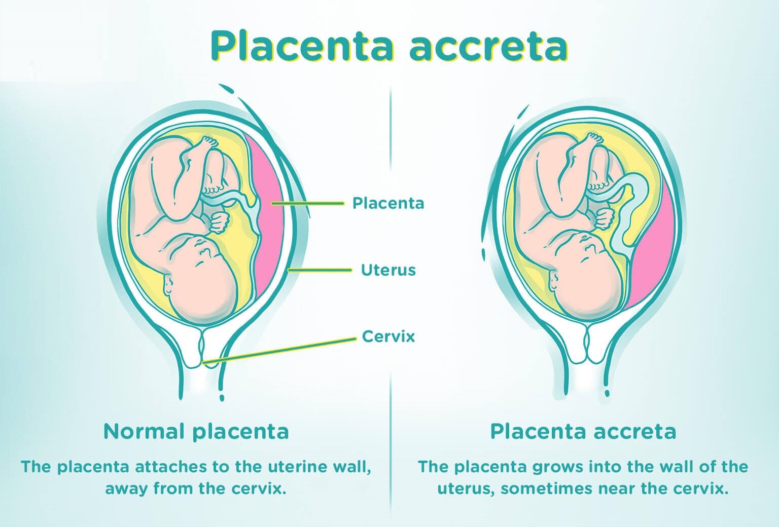  Placenta Accreta