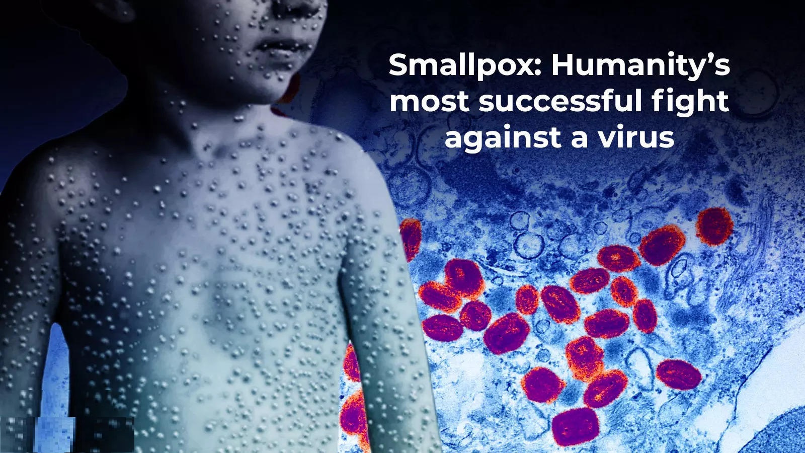 Smallpox - Symptoms, Causes, and Treatment