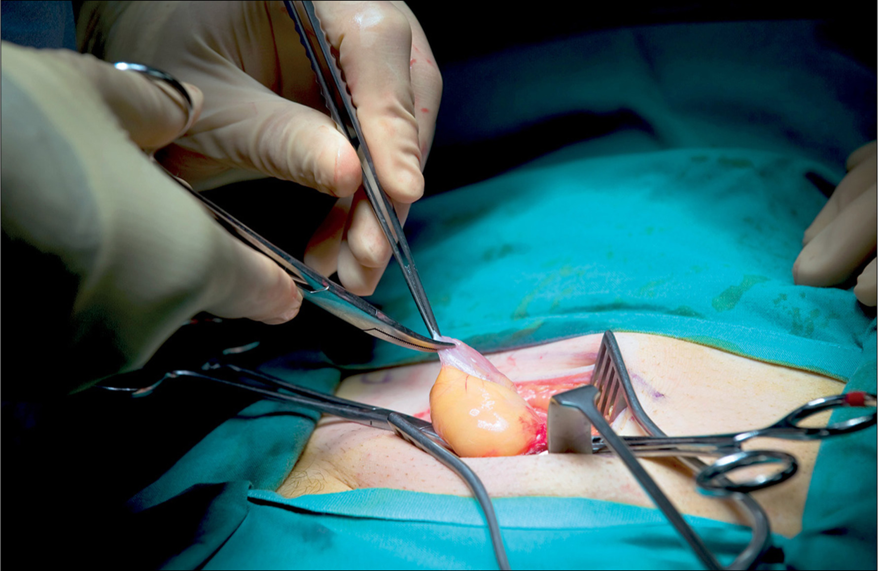 Ureteral Cancer Surgery