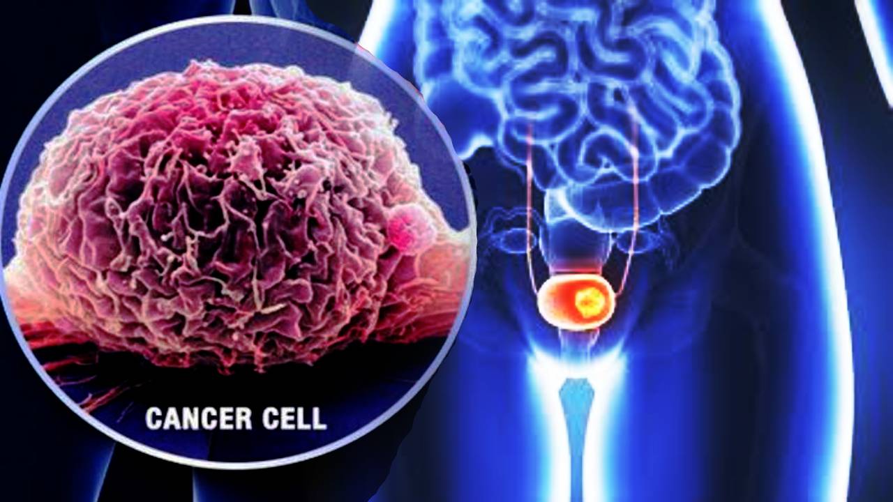 What is Ureteral Cancer? | Specialty Care Clinics