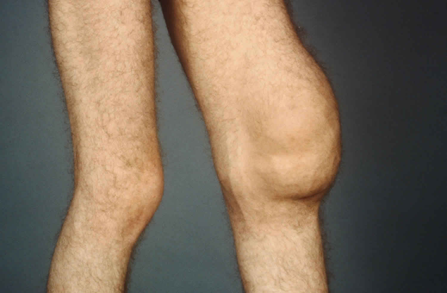 
                  Water on the Knee: Joint Effusion


 