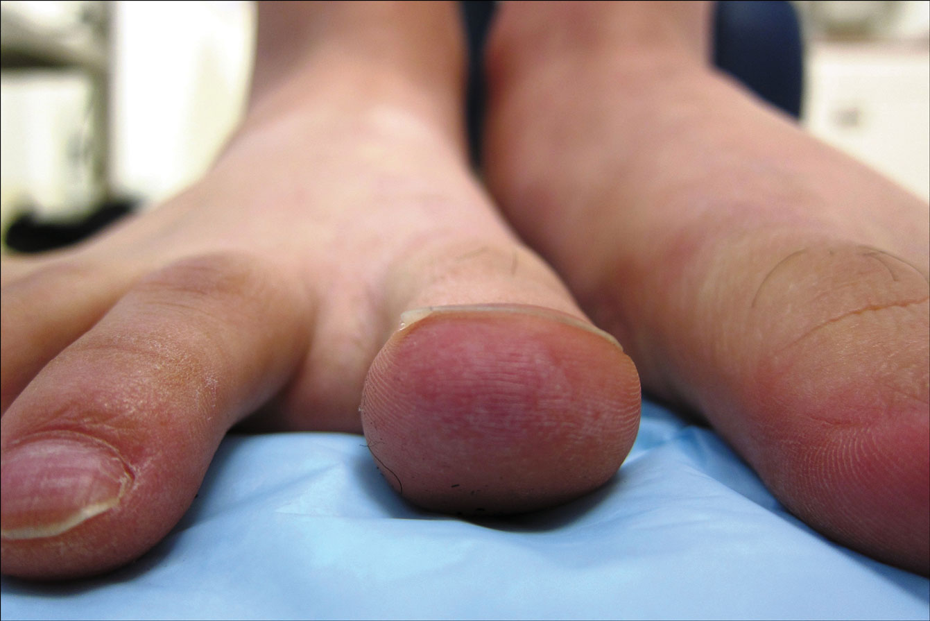 What is Chilblains?
