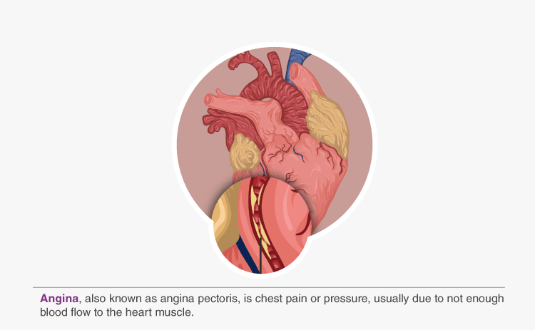 What is Angina? and Its Symptoms | Specialty Care Clinics
