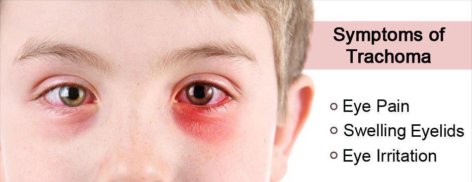 Trachoma Symptoms