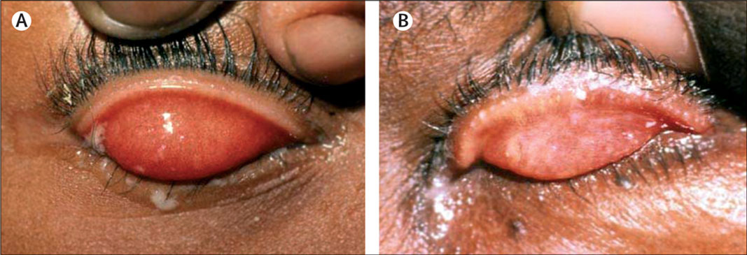 What is Trachoma?