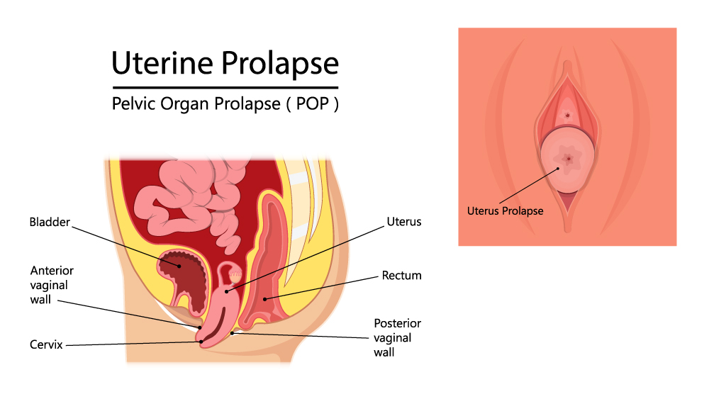 
                    What is an Uterine Prolapse?


 